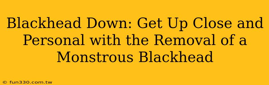 Blackhead Down: Get Up Close and Personal with the Removal of a Monstrous Blackhead